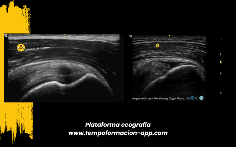 5. Ecografia tempo formacion manguito rotador tendon supraespinoso infraespinoso redondo menor subescapular.png